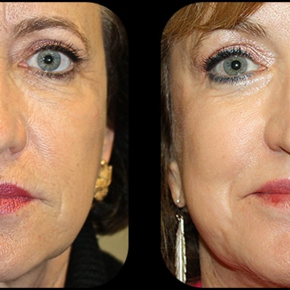 10% TCA Facial Peel - Picture 4 of 5